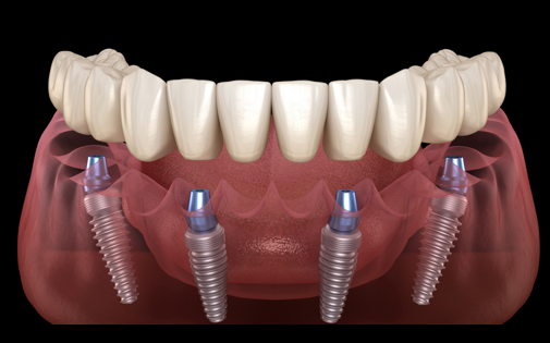 All On 4 İmplant