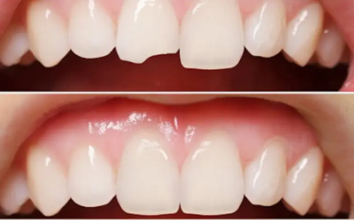 Estetik Dolgular (Bonding)