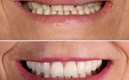 Full Porselen Kaplamalar