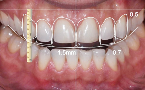 Dijital Gülüş Tasarımı