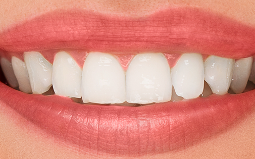 Estetik Gülüş Tasarımı