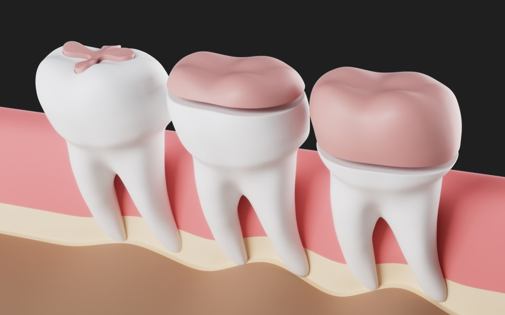 İnlay / Onlay Dolgular